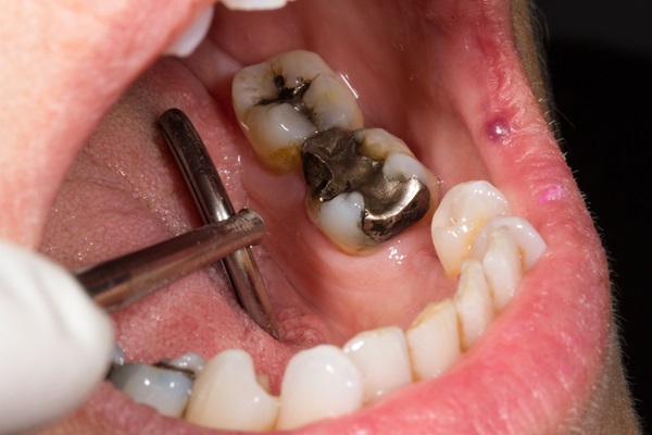 Signs You Should Have Your Silver Fillings Replaced