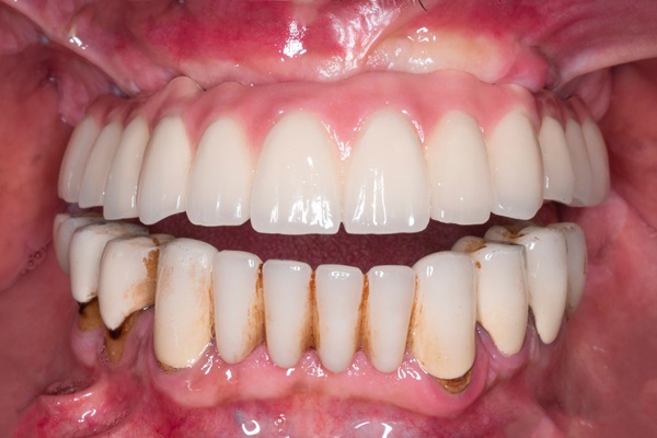 Popular Full Mouth Reconstruction Procedures